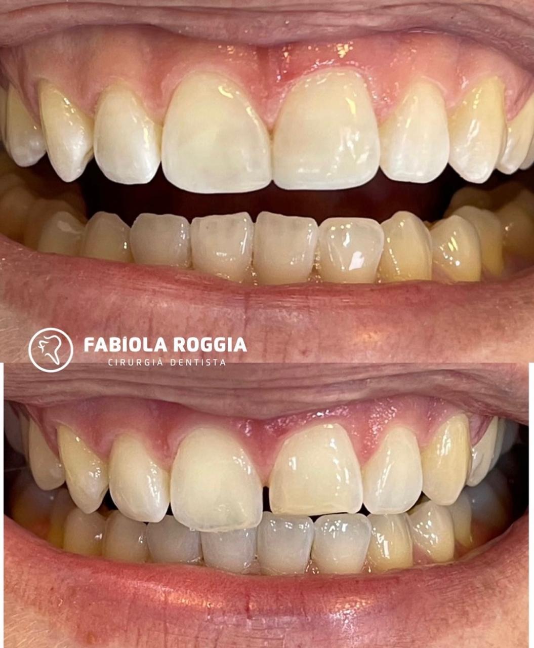 Reconstrução de dentes fraturados ou gastos