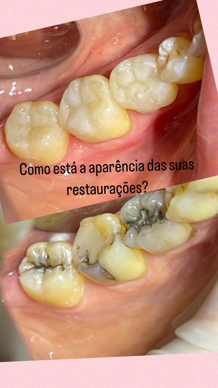 Substituição de restaurações de amálgama por resina composta