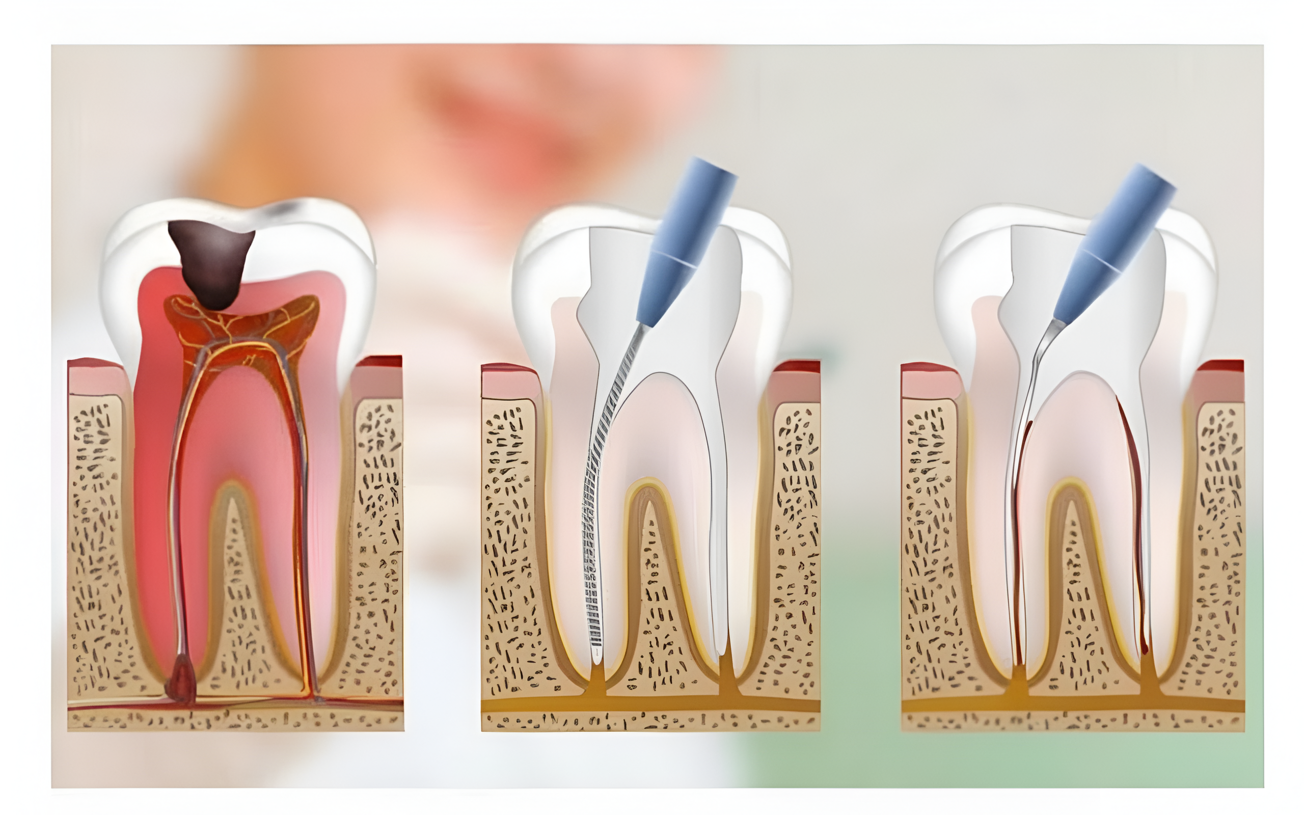Tratamento de Canal realizado pela Dra. Fabiola Roggia em Porto Alegre